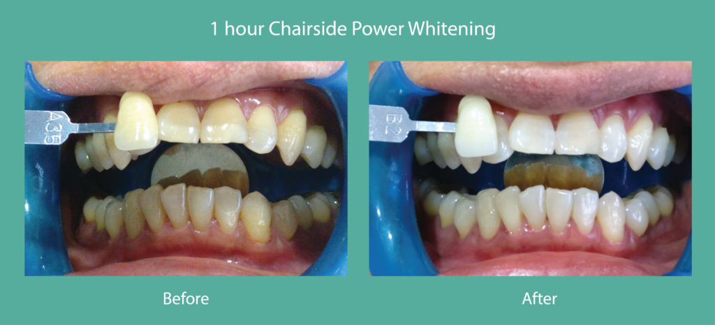 whitening22-02