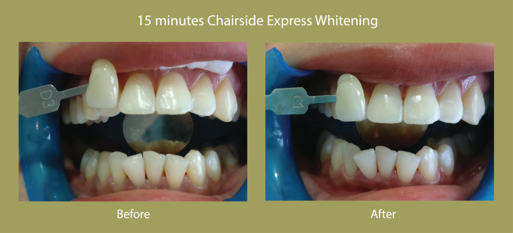 whitening3-02-02-02